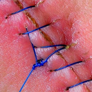 Vết rạch tầng sinh môn bao lâu sẽ lành lại? Cẩm nang phục hồi nhanh cho mẹ