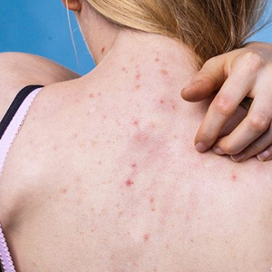 Top 5 spa trị viêm nang lông hiệu quả hàng đầu tại TP.HCM