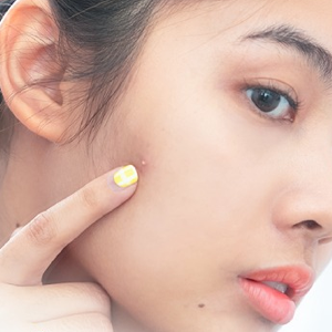 5 địa chỉ điều trị mụn uy tín, chất lượng nhất TP.HCM