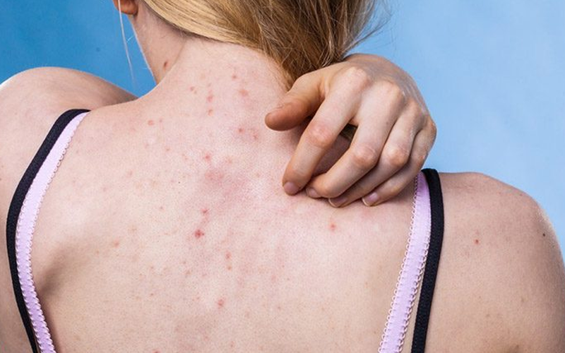 Top 5 Spa trị viêm nang lông hiệu quả hàng đầu tại TP.HCM