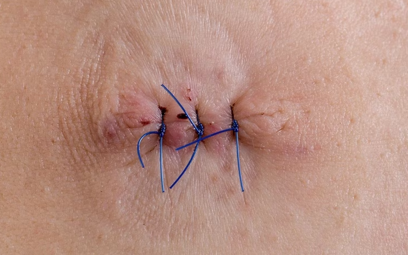 Vết rạch tầng sinh môn bao lâu sẽ lành lại? Cẩm nang phục hồi nhanh cho mẹ