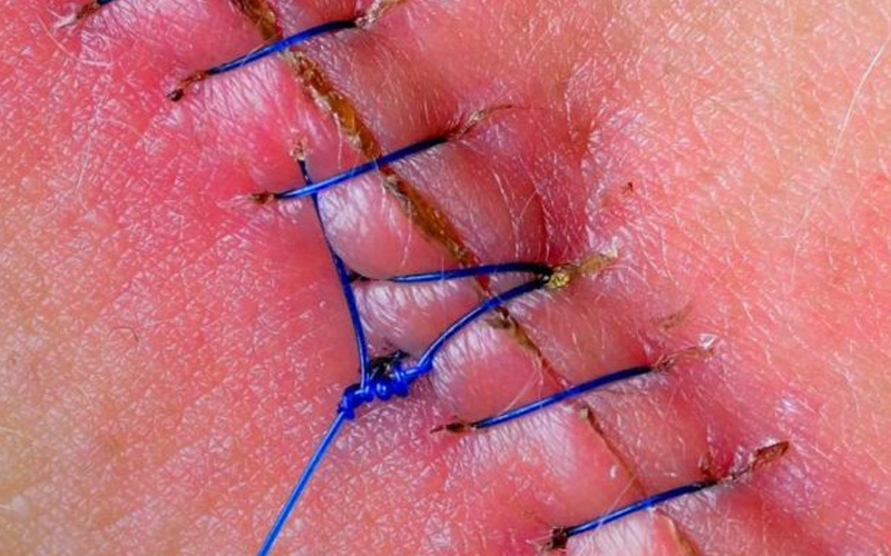 Vết rạch tầng sinh môn bao lâu sẽ lành lại? Cẩm nang phục hồi nhanh cho mẹ